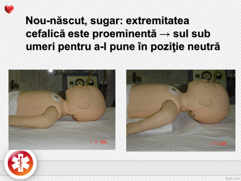 Nou-născut, sugar: extremitatea cefalică este proeminentă → sul sub umeri pentru a-l pune în